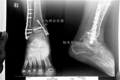 患者手术后腿里遗留钻头 院方称危害不大